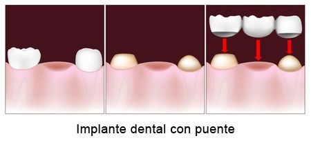 Implante dental con puente