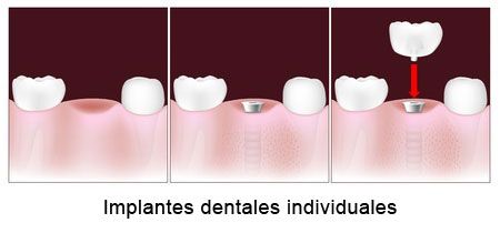 Implantes dentales individuales