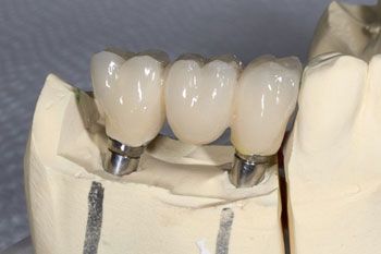 Implantes dentales