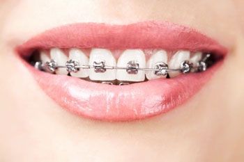 Ortopedia dental con brackets