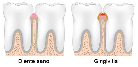 Periodoncia: diente sano y gingivitis