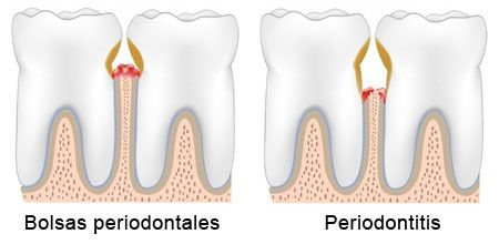 Periodoncia: bolsas periodontales y periodontitis