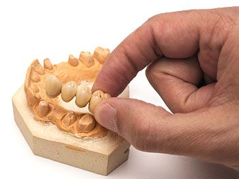 Prótesis dentales puentes y fundas