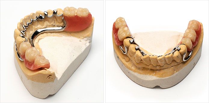 Prótesis dentales a medida